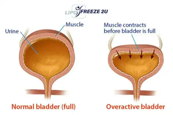 diagram of overactive bladder treatment Bridgend