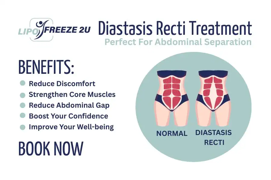 Benefits of body toning treatment Bridgend for Diastasis recti