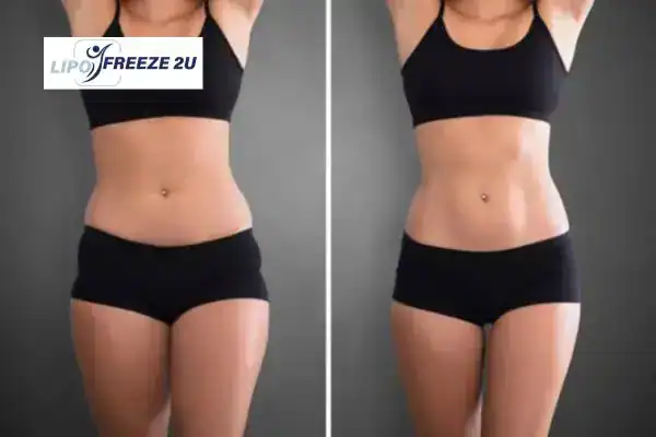 How Can LIPO FREEZE 2U Support Your Post-Pregnancy Body Recovery Bridgend?