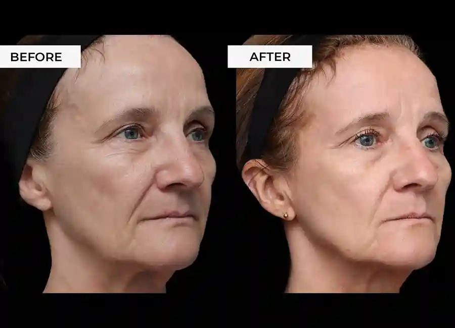 How Many RF Microneedling Sessions Will You Need to See a Difference Bridgend?