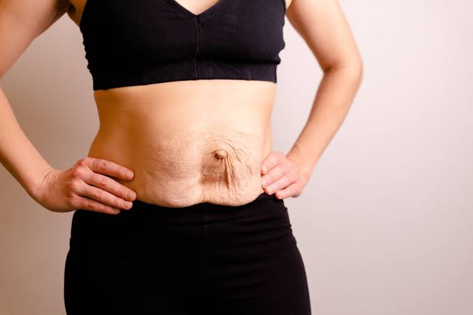 Is Surgery Really the Only Way to Repair Diastasis Recti Bridgend?