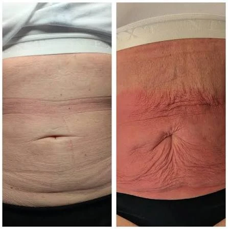How Does RF Microneedling Improve Crepey, Thin and Uneven Skin Texture Bridgend?