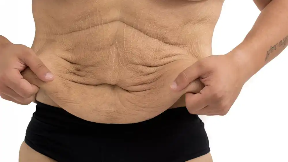 Why Does Weight Loss Medication Leave Some People With Loose or Sagging Skin Bridgend?